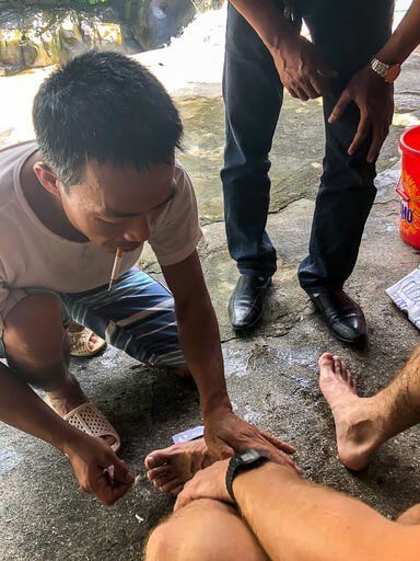 Mark having a leech removed by Vietnamese man near Hue Vietnam