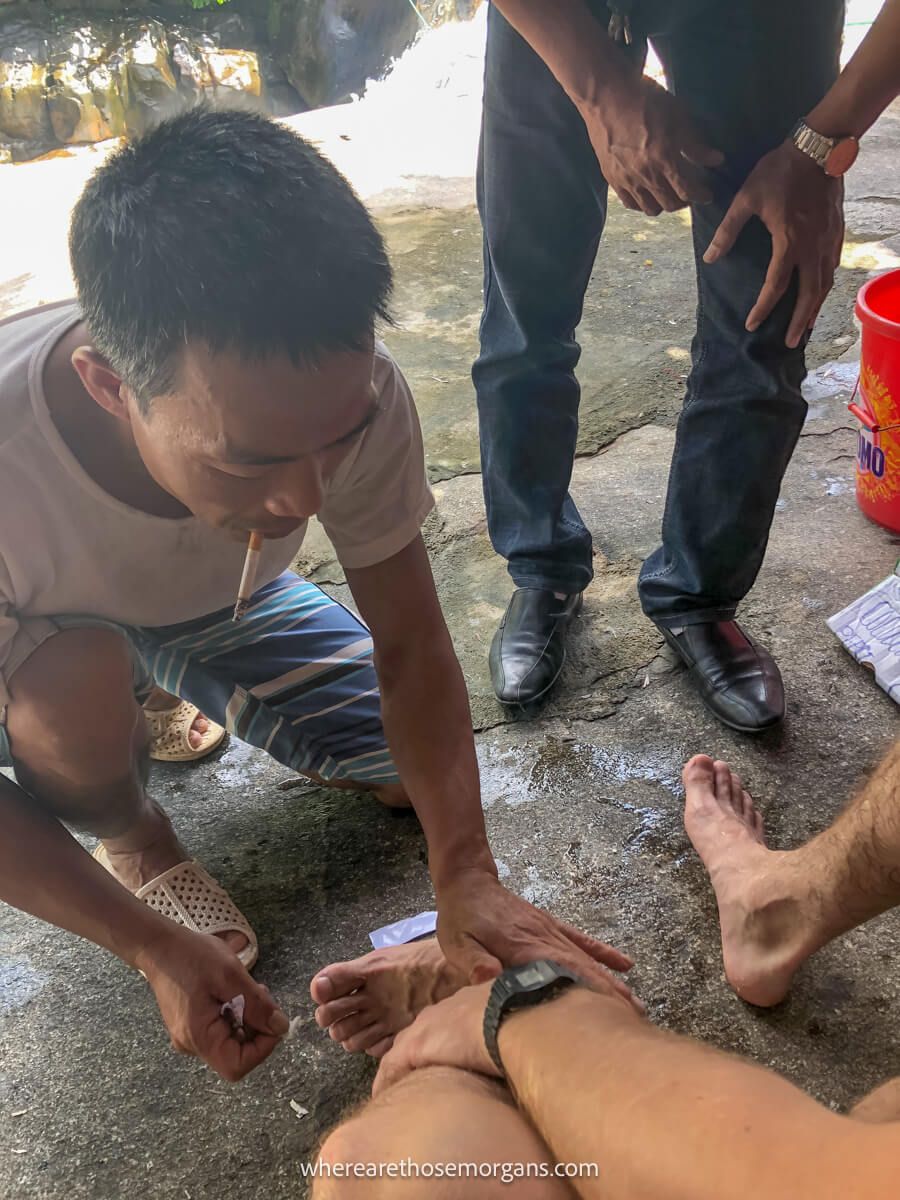 Man with a cigarette helping a man burn a leech of his leg