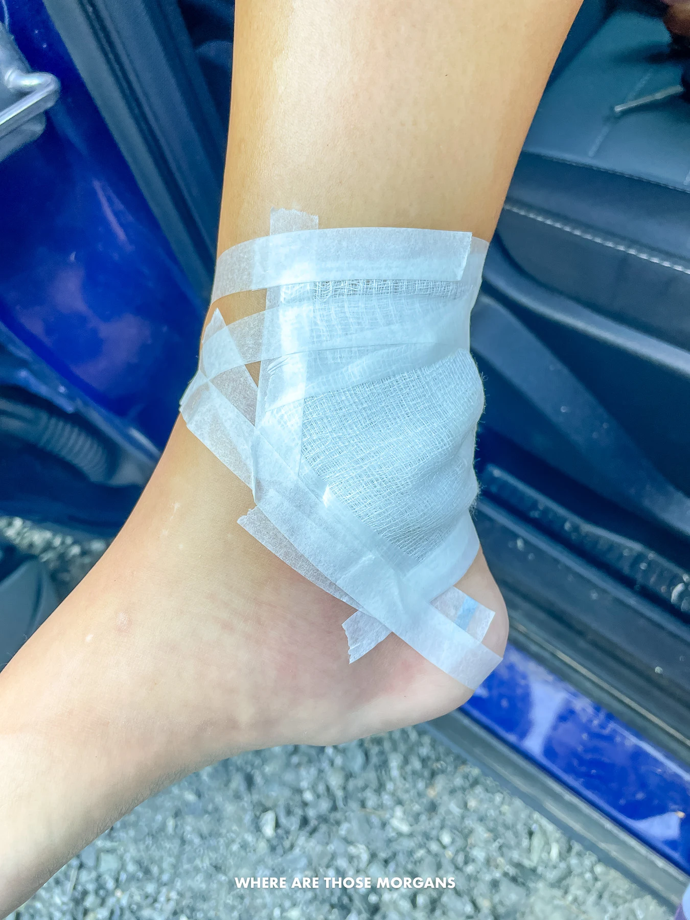 Woman with her ankle bandaged after a bee sting